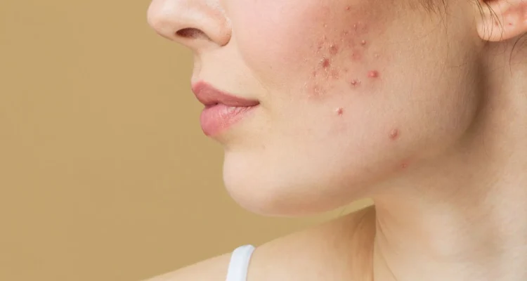 Tips Menghilangkan Jerawat Secara Alami dan Efektif